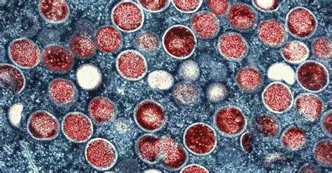 cebu city health department photos|5 suspected mpox cases probed .